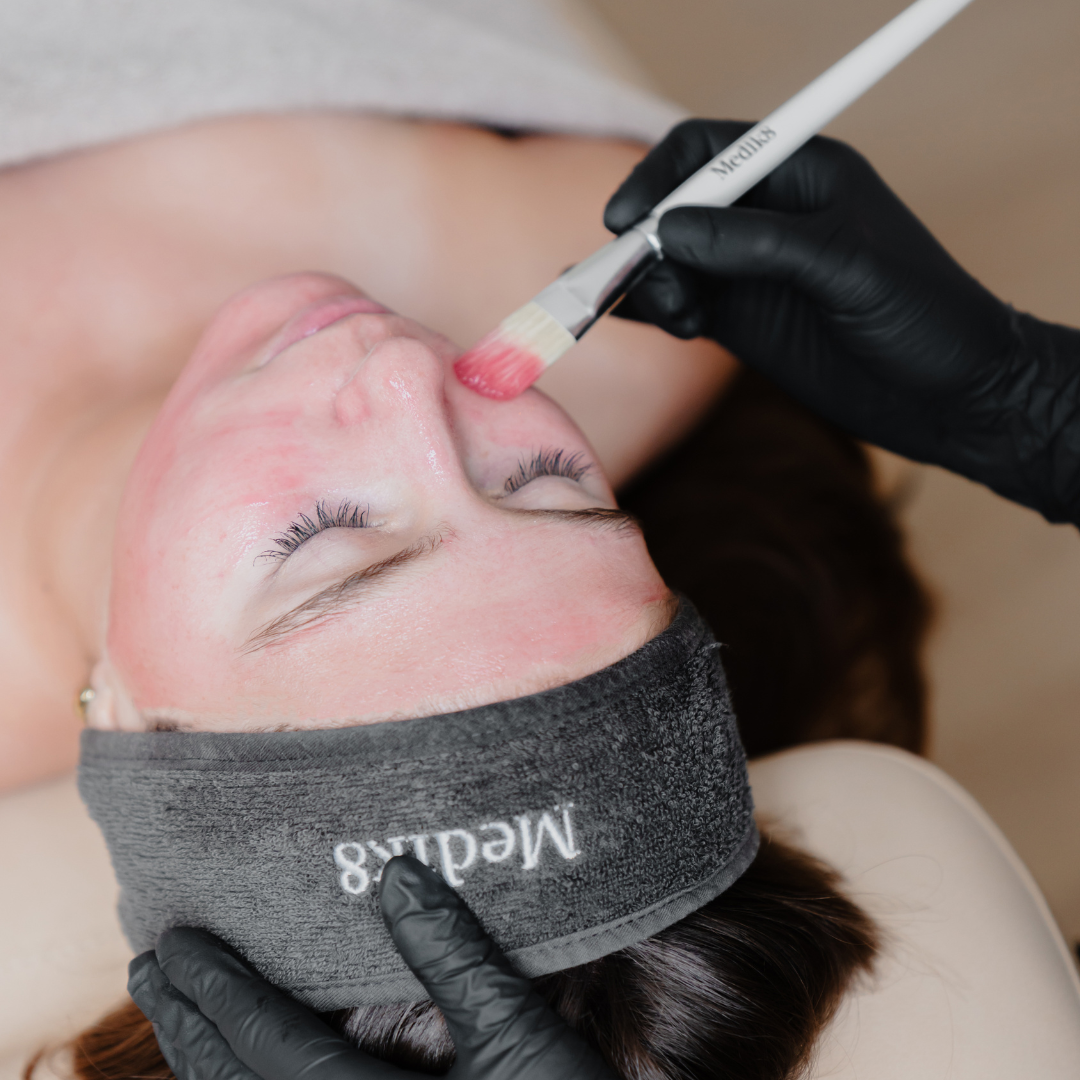 Medische Peeling Bij - Sisu Clinic Breda